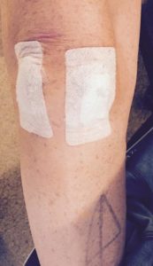 London Marathon 2016 is the goal despite knee surgery as seen in this picture taken by cancer survivor Simon Bush. Read thegoodista.com for more. 